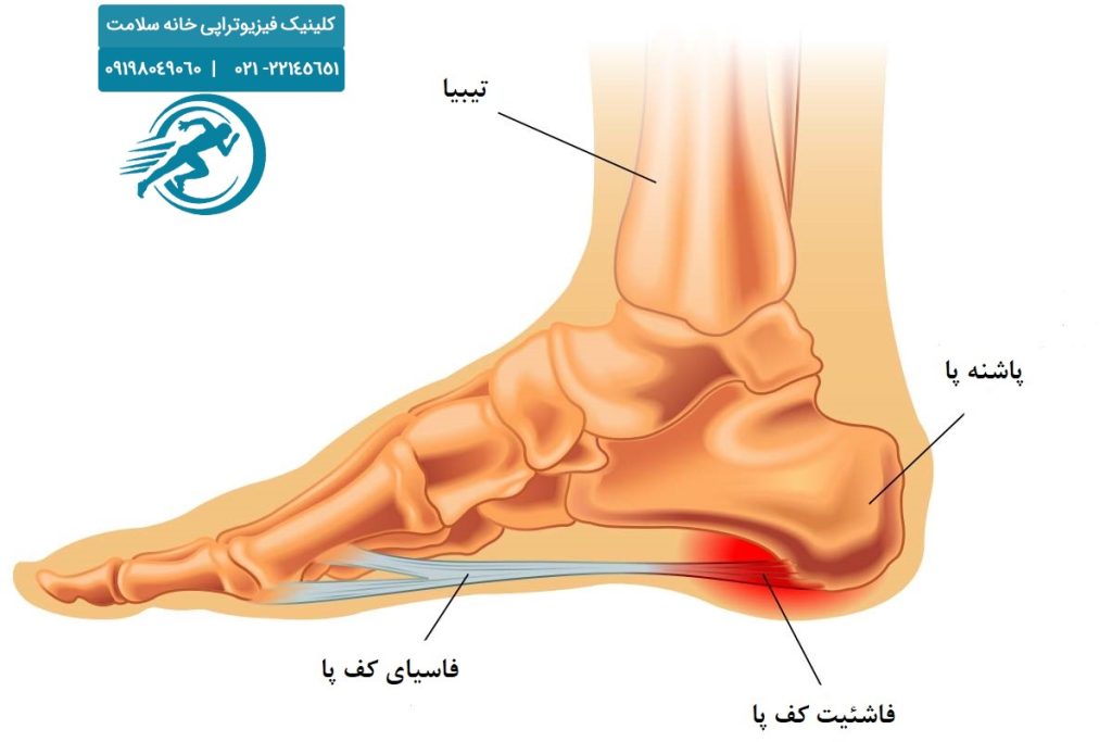 درمان خارپاشنه در منزل