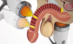 شاک ویو تراپی نعوظ چیست؟ راهنمای کامل درمان مشکلات نعوظ
