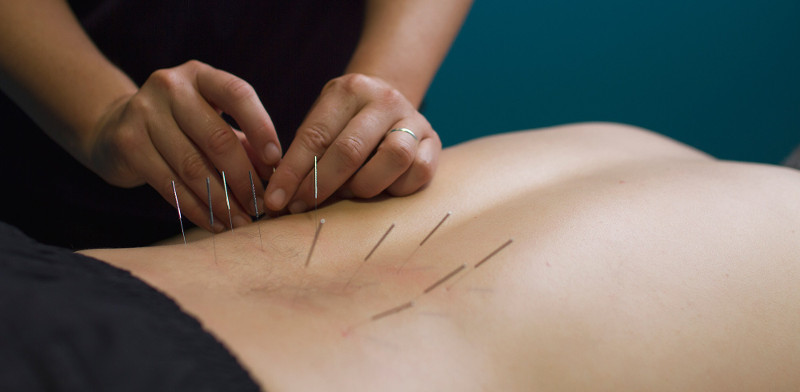 درای نیدلینگ (Dry Needling)