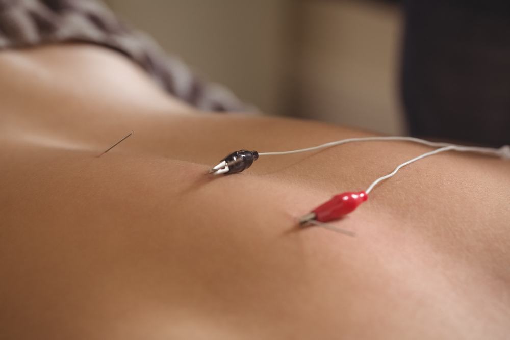 الکترو آکوپانکچر (Electroacupuncture)