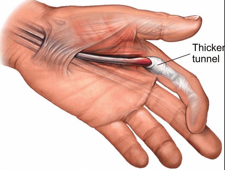 تریگر فینگر یا انگشت ماشه‌ای چیست؟