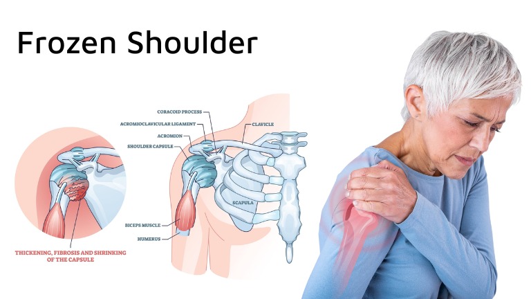 شانه یخ زده یا Frozen shoulder