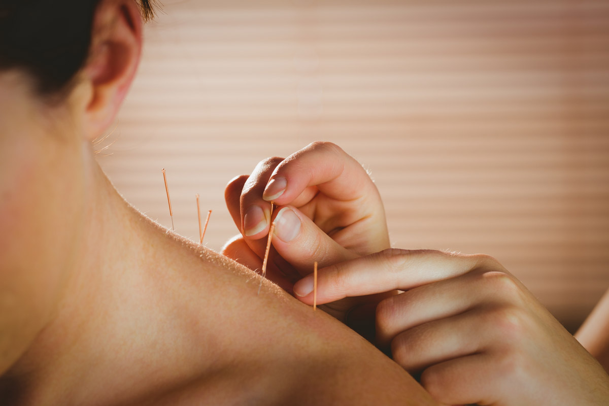 طب سوزنی در فیزیوتراپی