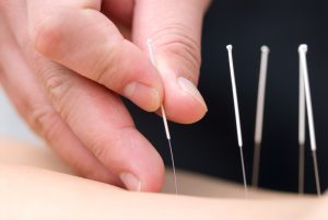 طب سوزنی چیست؟ صفر تا 100 درمان انواع بیماری‌ها