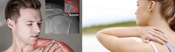 تشخیص بورسیت شانه