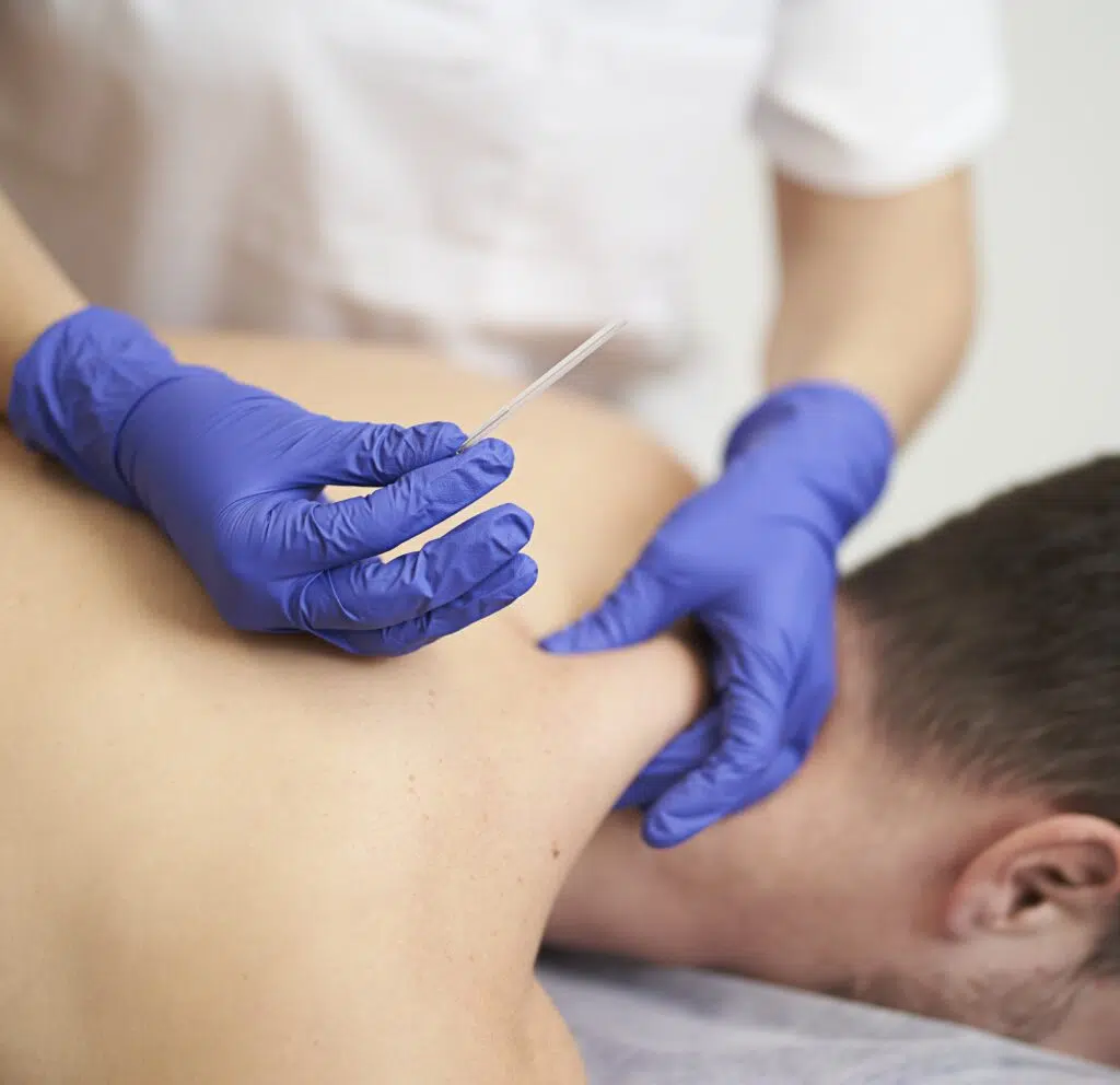 درای نیدلینگ در فیزیوتراپی