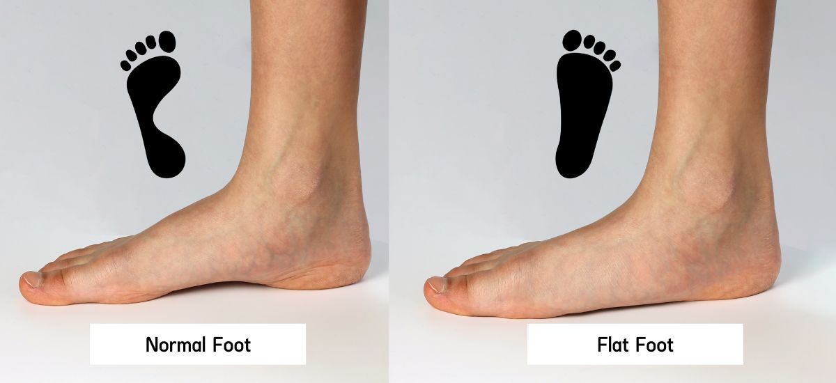 درمان صافی کف پا