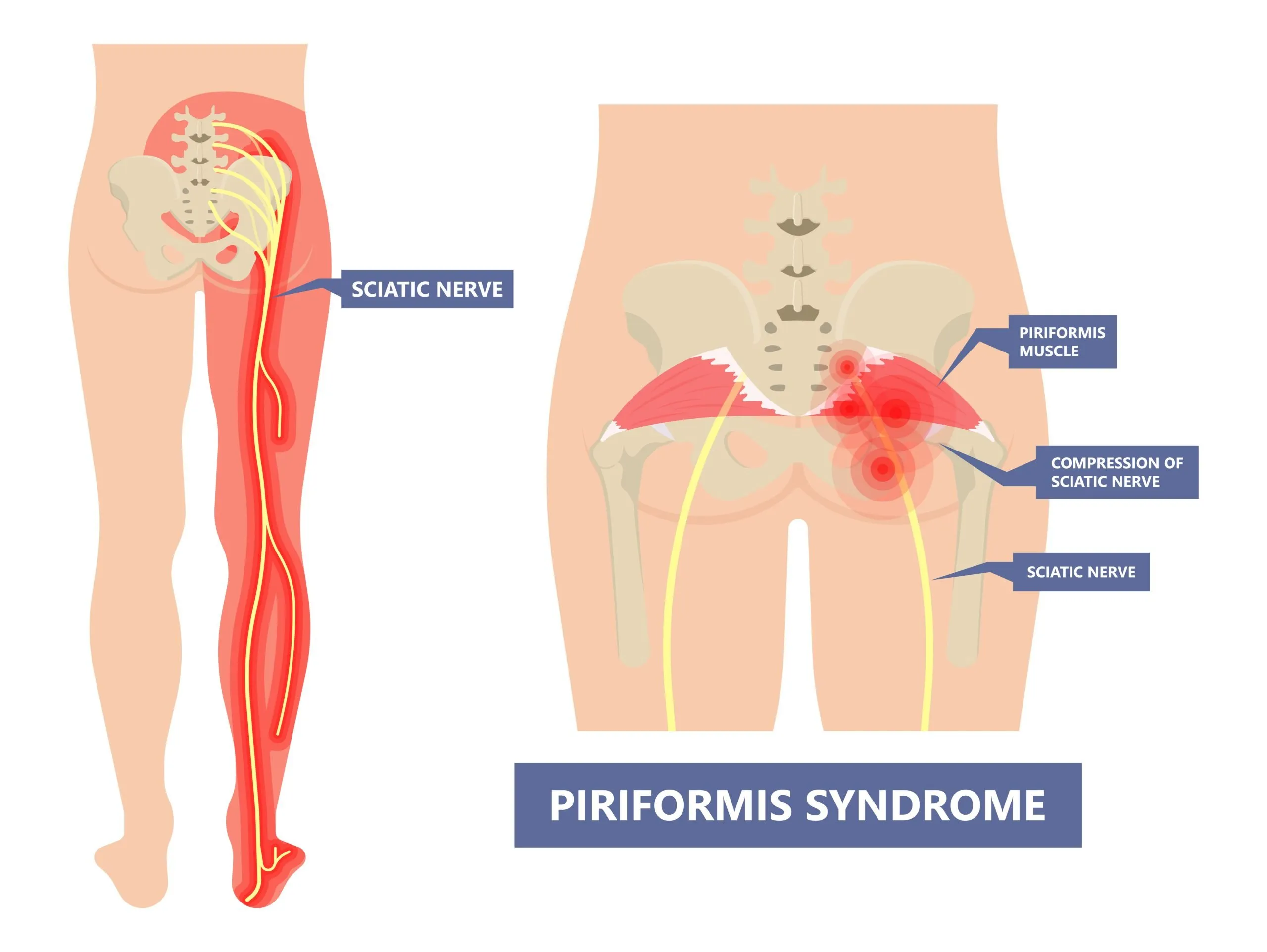 سندروم پیریفورمیس piriformis syndrome