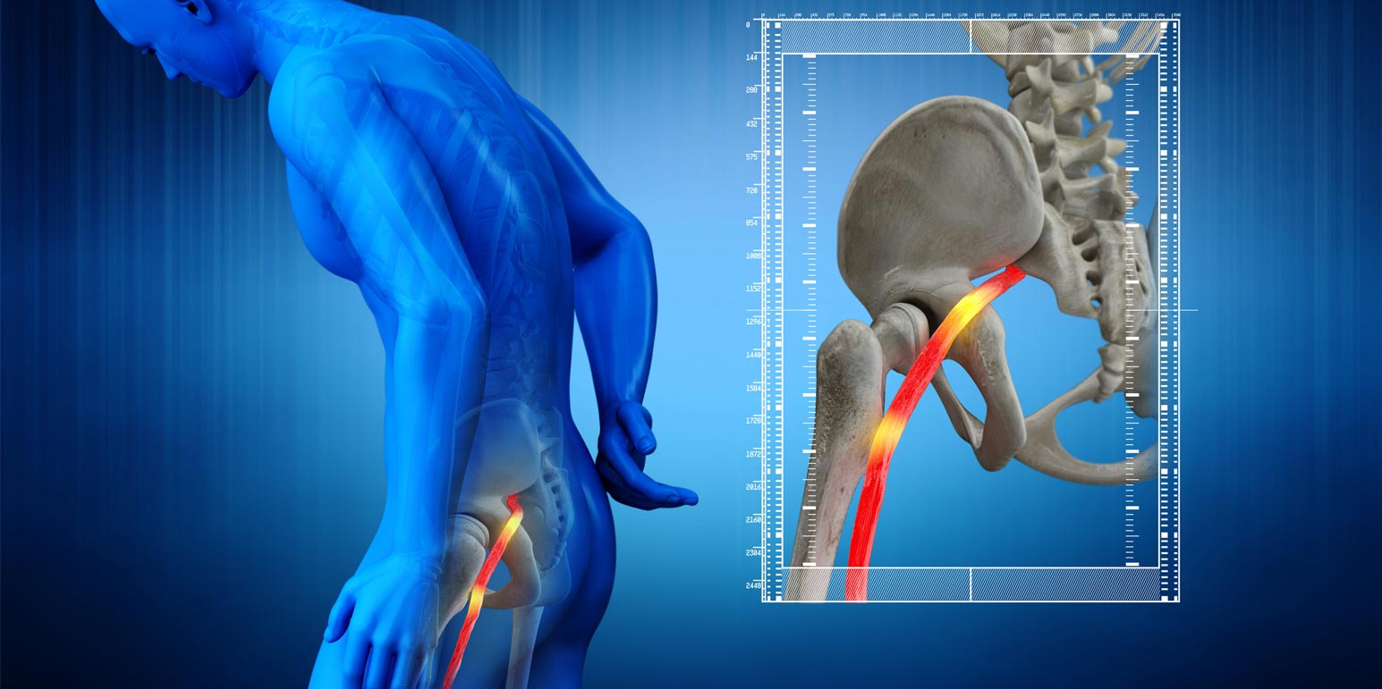 سیاتیک چیست و چرا ایجاد میشود؟