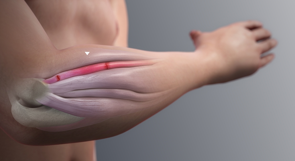 درد ساعد دست راست و چپ