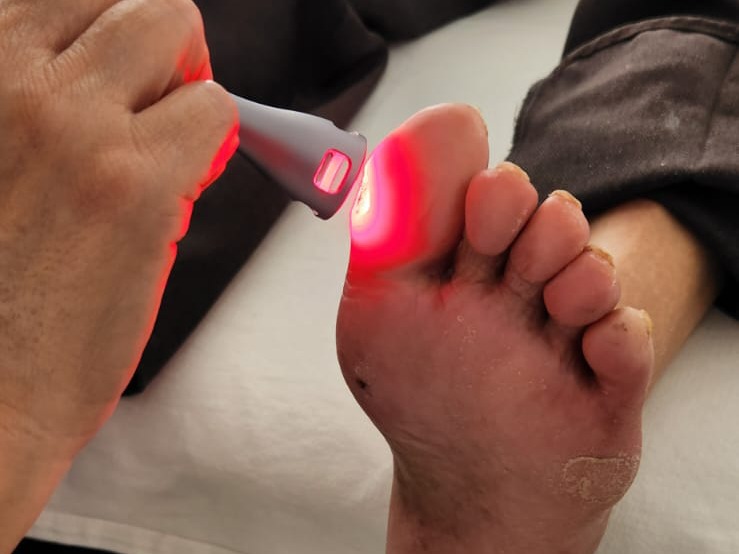 لیزر کم توان و تاثیر آن بر ترمیم و درمان زخم پای دیابتی