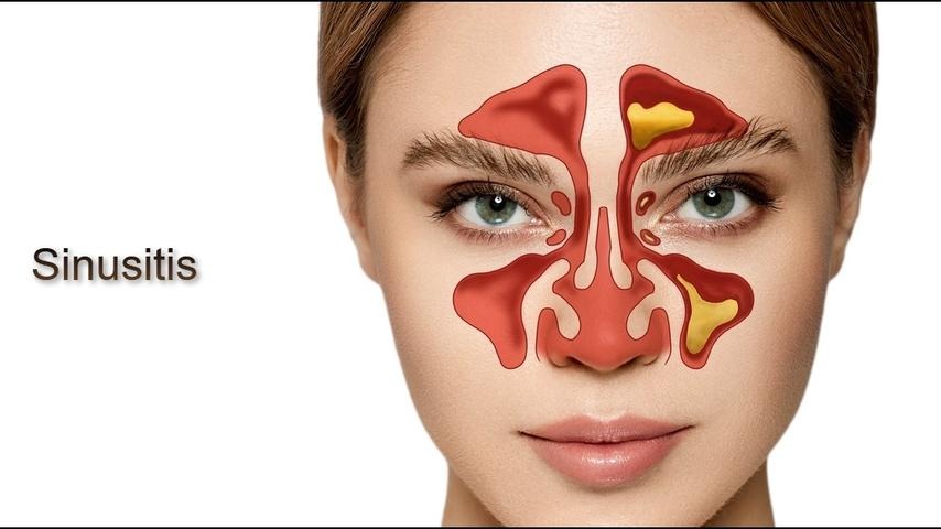 سینوزیت چیست و چه علائمی دارد؟
