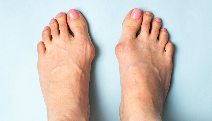 انحراف شست پا یا هالوکس والگوس