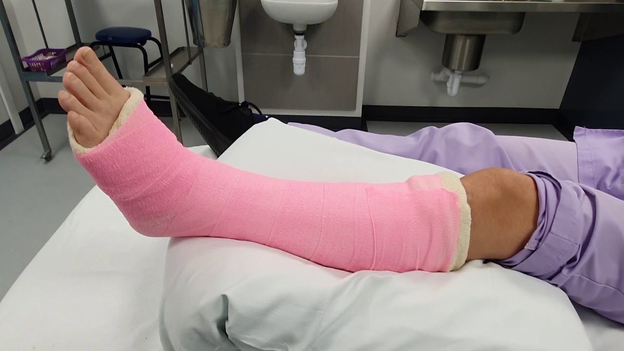 طرز خوابیدن با پای گچ گرفته