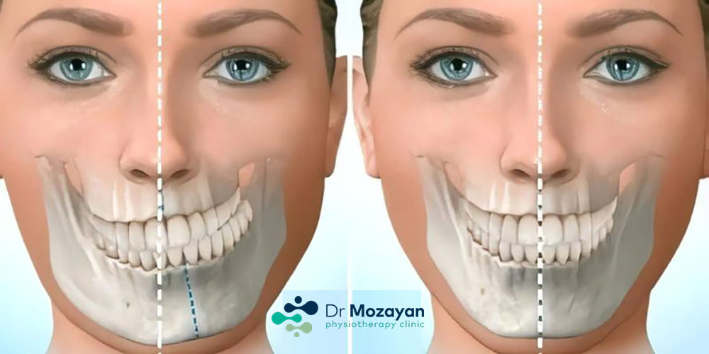 درمان کجی فک