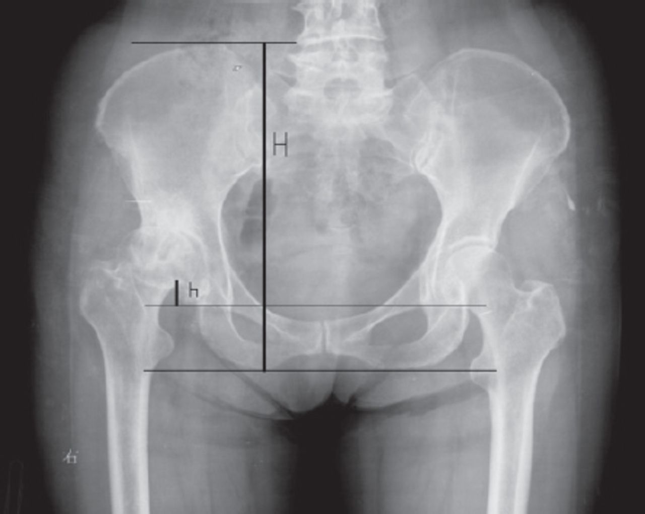 عکس لگن نامتقارن