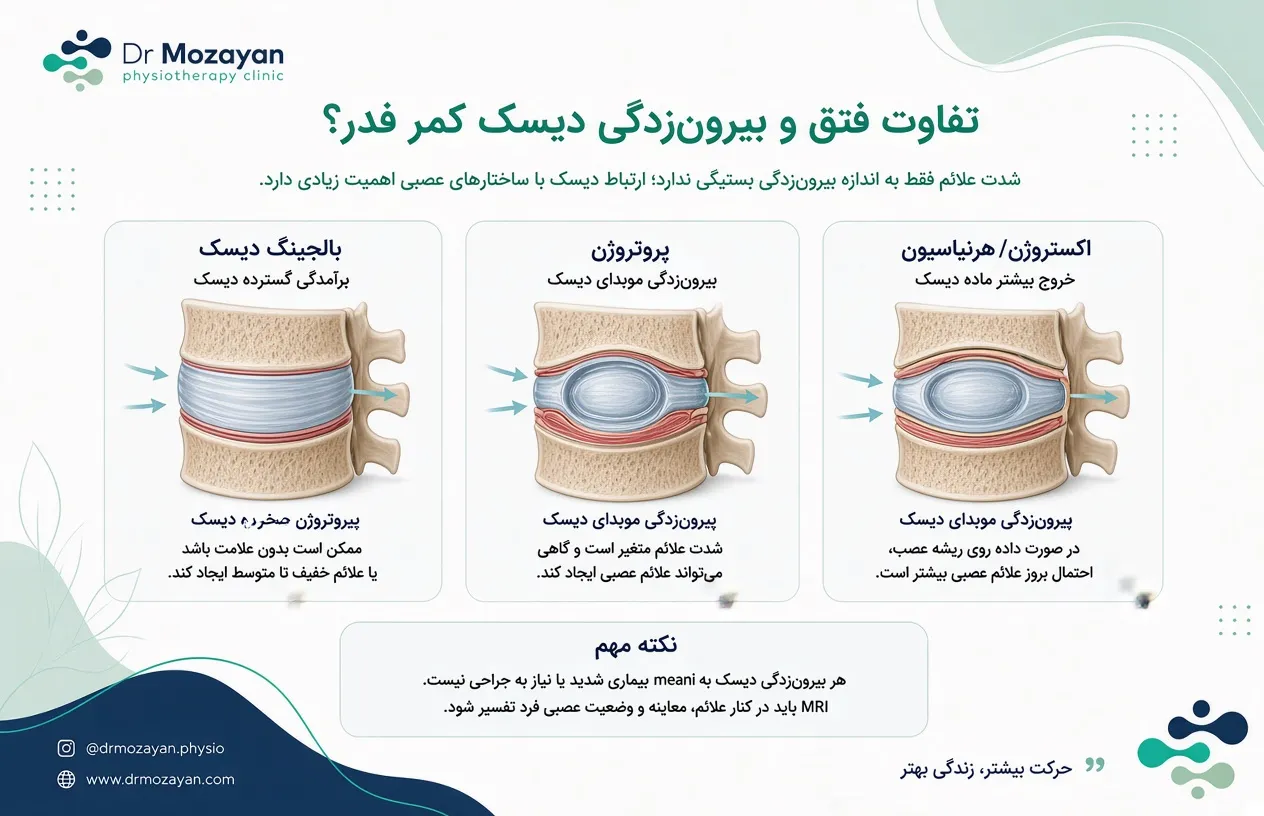 فرق فتق دیسک کمر با بیرون زدگی کمر