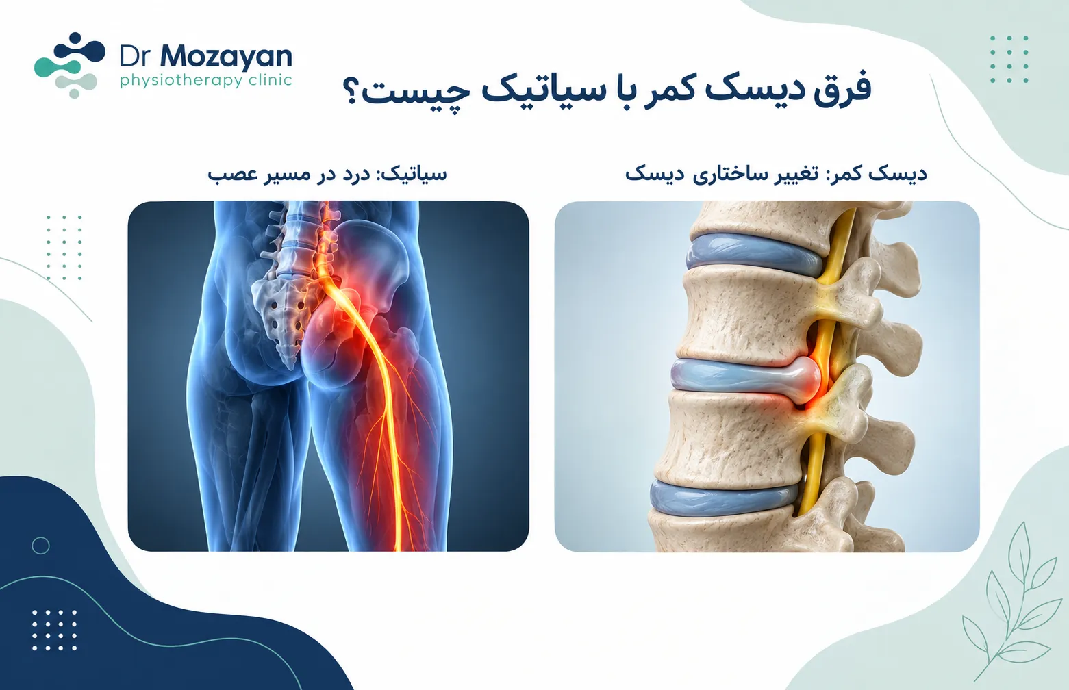 نوع درد سیاتیک و دیسک کمر