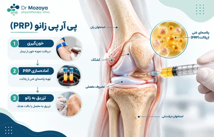 مراحل تزریق PRP زانو
